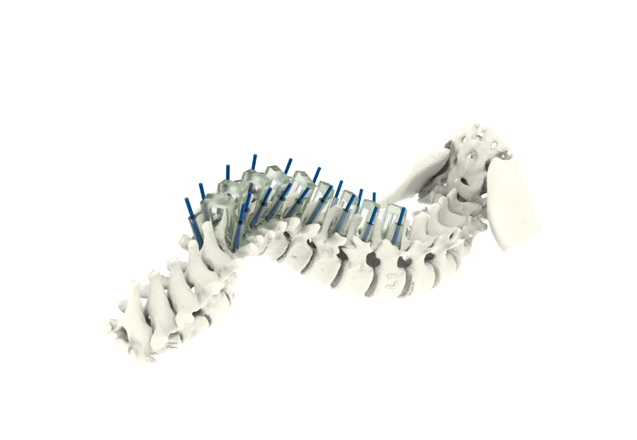 3D打印手术导板三甲医院